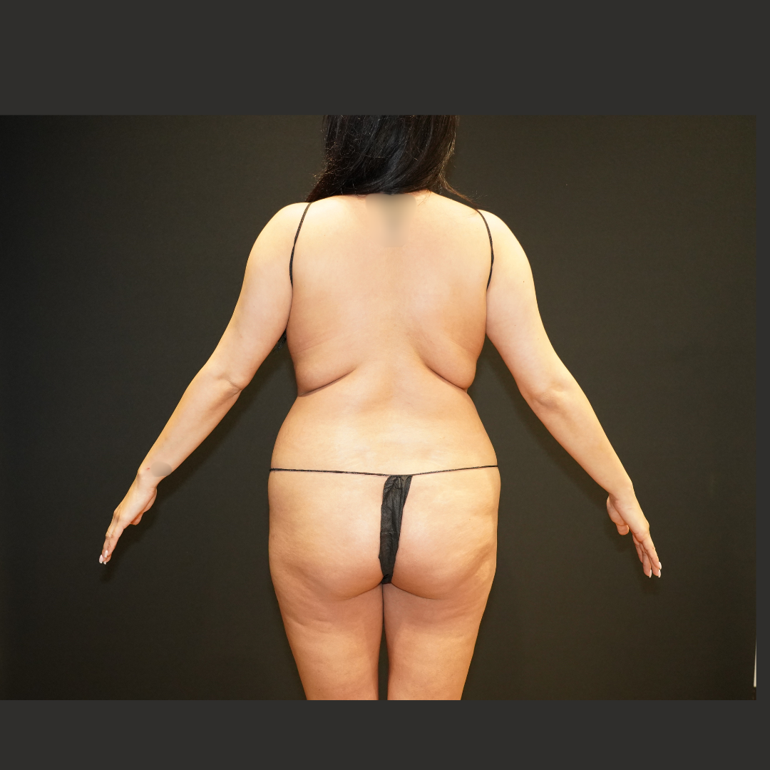 Liposuction patient before, back view