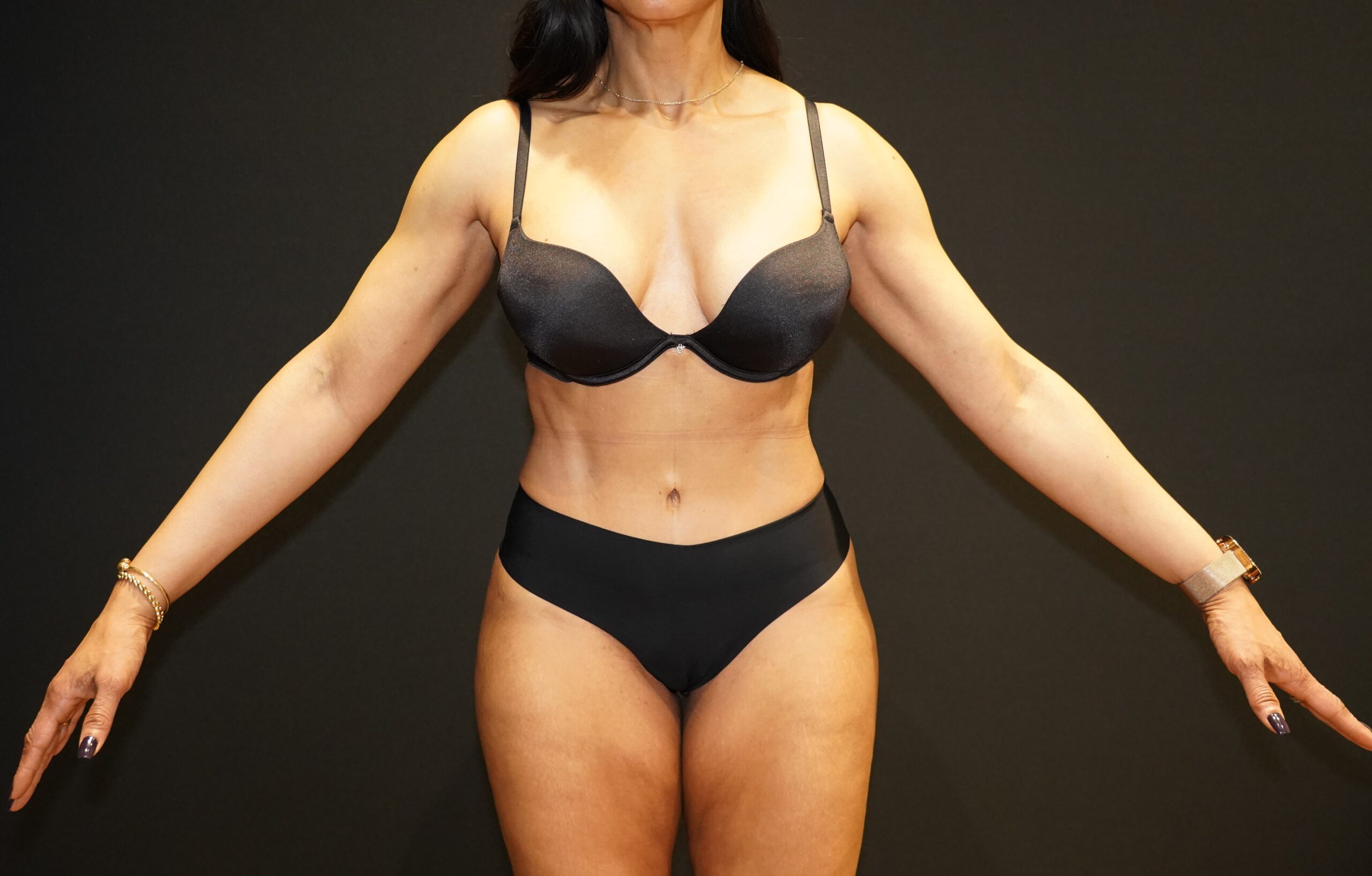 Tummy tuck patient after, frontal view