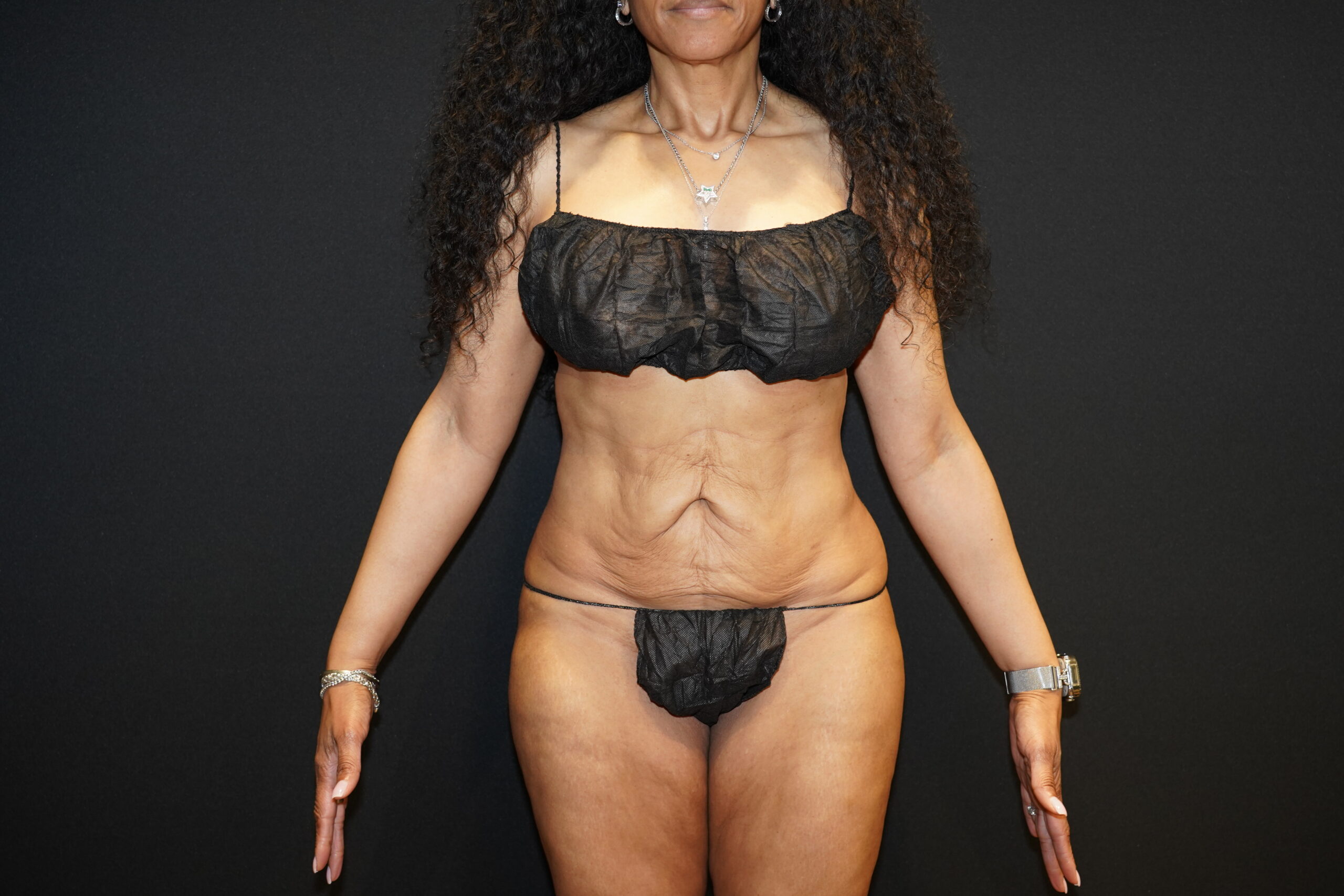 Tummy tuck patient before, frontal view
