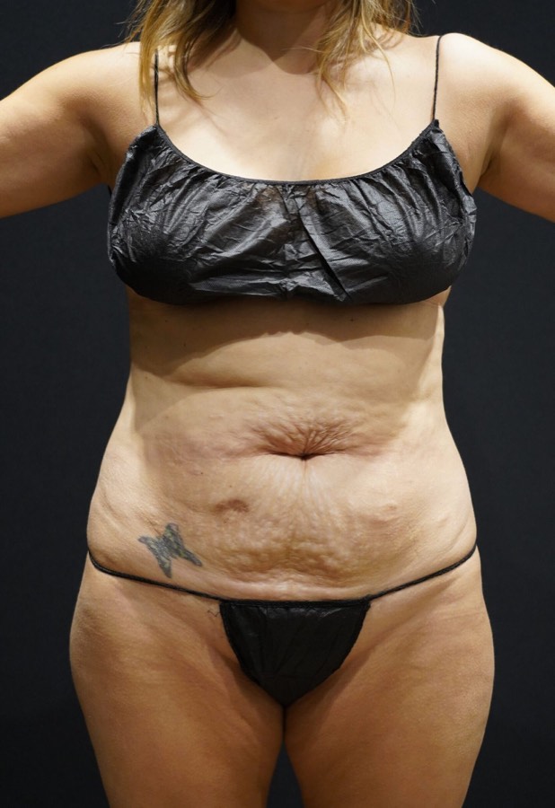 Tummy tuck patient before, frontal view